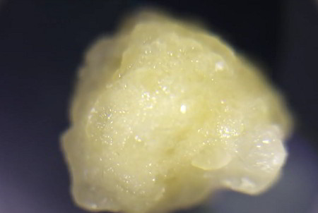 Close-up of large yellow-white kidney stone