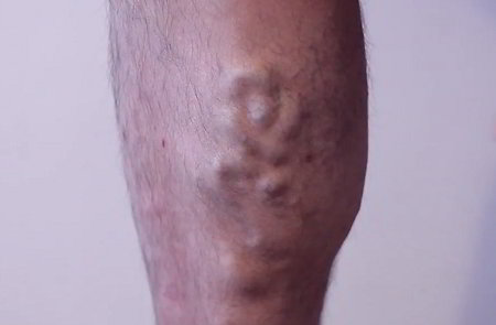 Man's rear lower right leg with bulging varicose veins