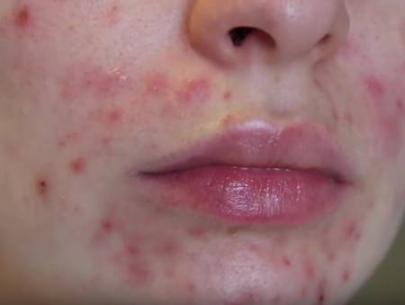 Woman with adult acne on cheeks and around mouth
